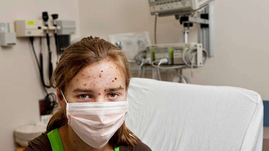 Viruela - Epidemias | El Regreso del Monstruo Desfigurador